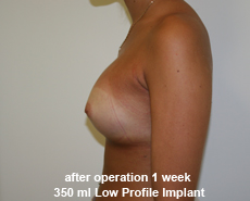 plastic-surgery-breast-augmentation